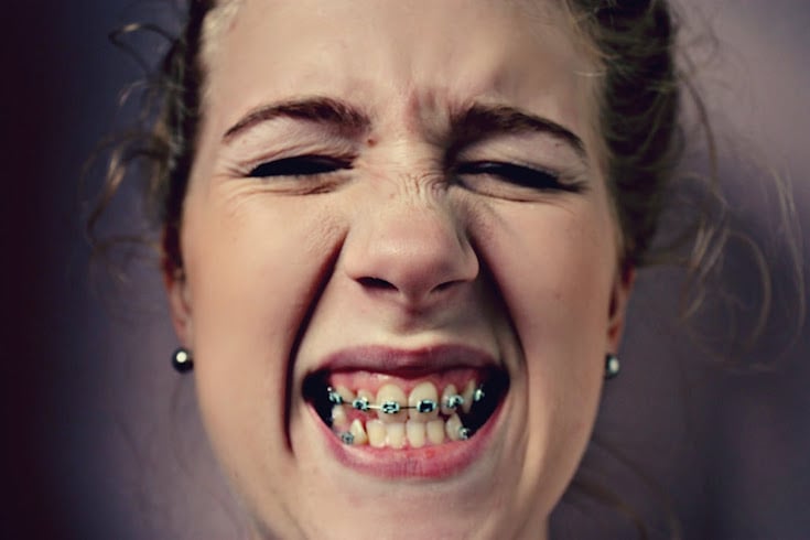 Comportamento: 15 coisas que só quem usou aparelho nos dentes pode entender
