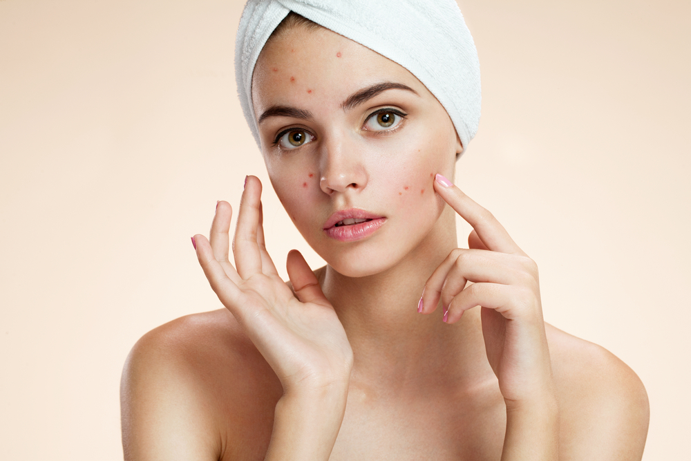 7 mitos e verdades sobre a acne