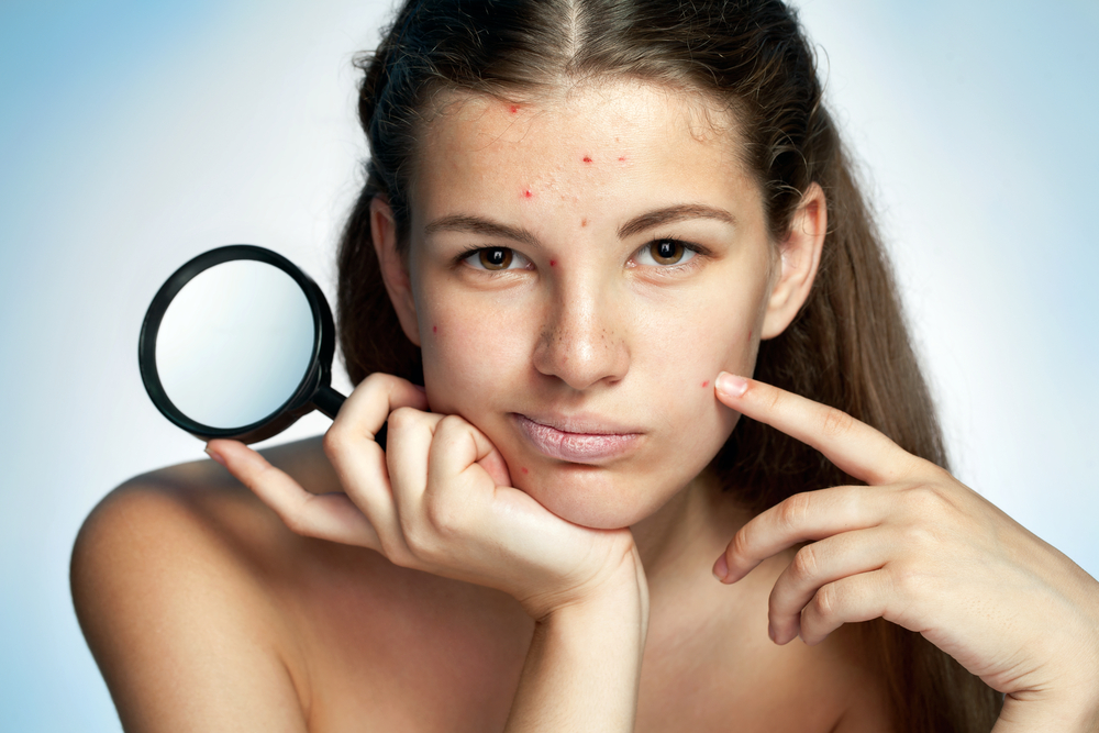 Acne é pior na adolescência? 